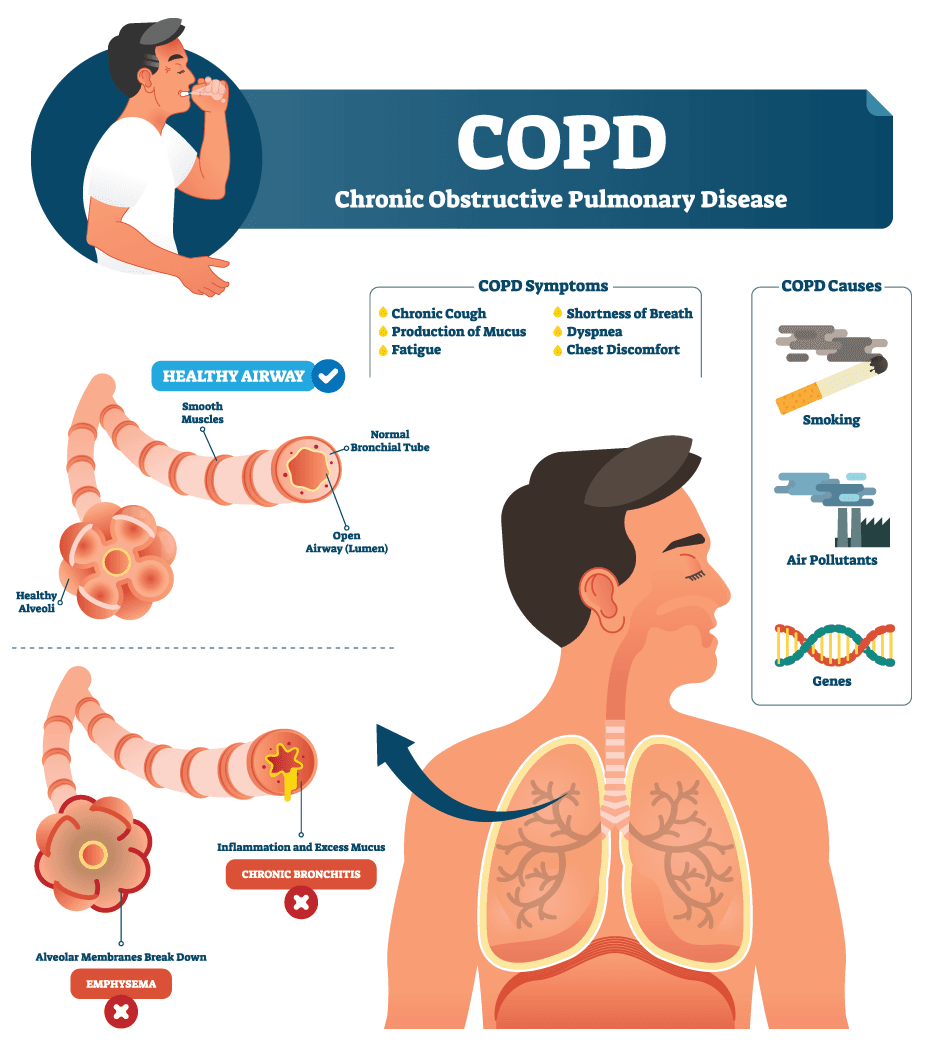 Tips to Follow When Living With COPD